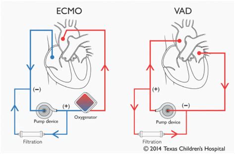 lvad vs ecmo